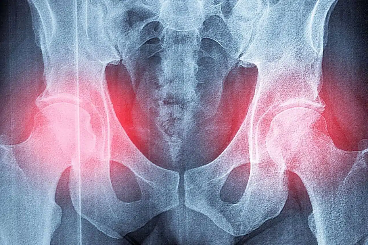 Medical illustration of a pelvic X-ray showing the effects of osteoporosis on bone density